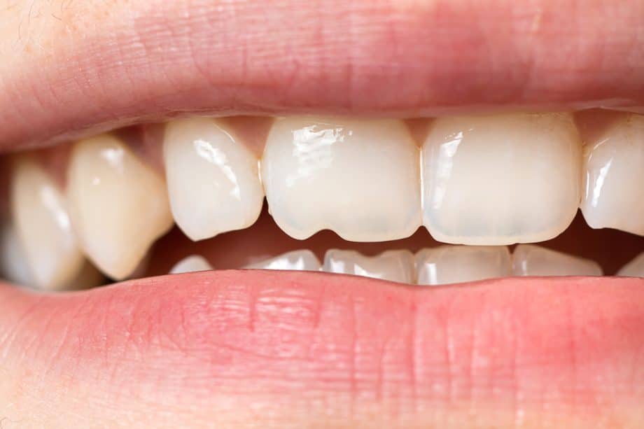 Fixing Chipped or Misshapen Teeth in Kids: Cosmetic Options for Young Smiles