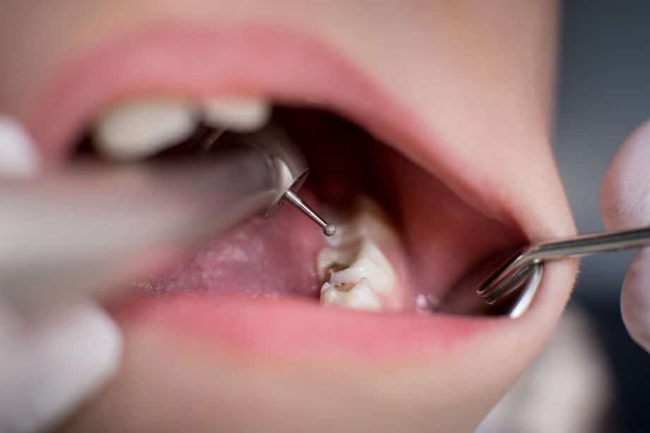 Patient getting fillings
